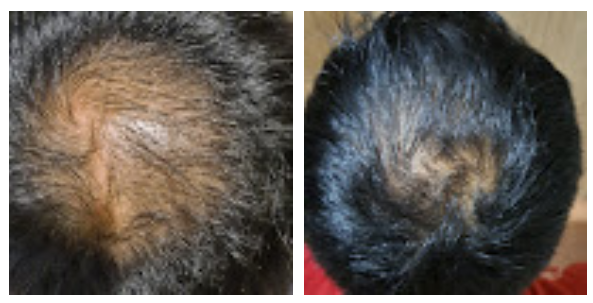 rambut rontok